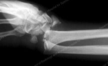 Fracture-dislocation of the Distal Radius